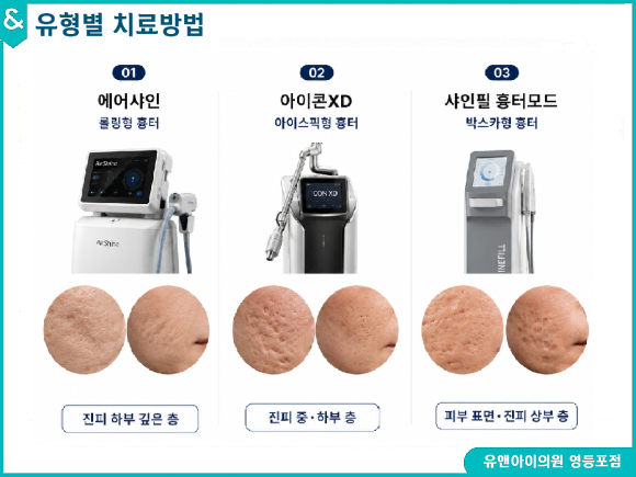 Yeongdeungpo Acne Scars: If They Concern You, You Need to Identify the Cause First image 4