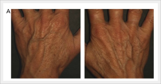 레디어스 손등 주름 시술 효과 어떨까? 관련 이미지 1