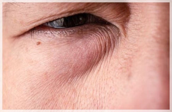 눈밑처짐 리프팅 아이울쎄라로 가능할까? 관련 이미지 8