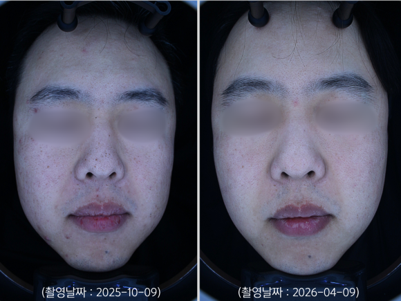A Yeongdeungpo Man’s Blemishes and Enlarged Pores: How Were They Actually Treated? image 4