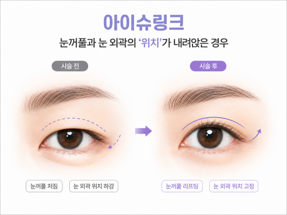 아이슈링크 vs. 아이올리지오 뭐가 좋을까 관련 이미지 6