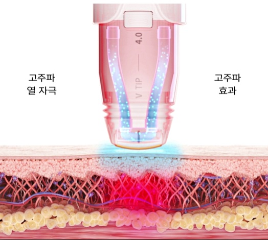 슈링크 볼뉴머 같이 받으면 뭐가 달라 질까? 관련 이미지 2