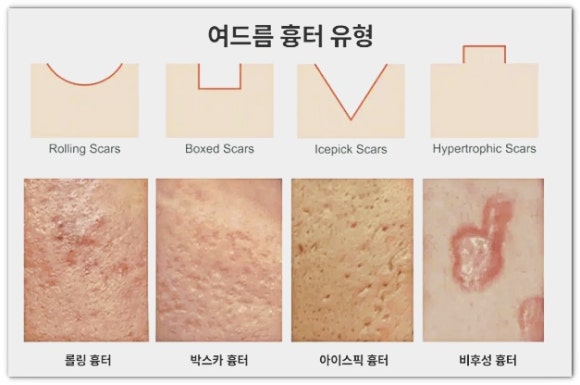영등포여드름피부과 진료, 재발과 흉터 어떻게 막을까? 관련 이미지 5