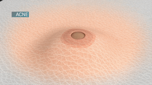 영등포여드름피부과 진료, 같은 자리에 자꾸 재발한다면? 관련 이미지 7