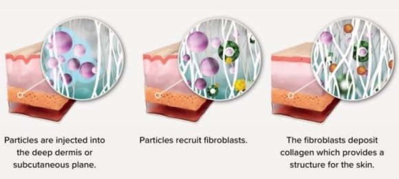 리쥬란힐러 용량 2cc, 4cc 효과 차이는? 관련 이미지 2
