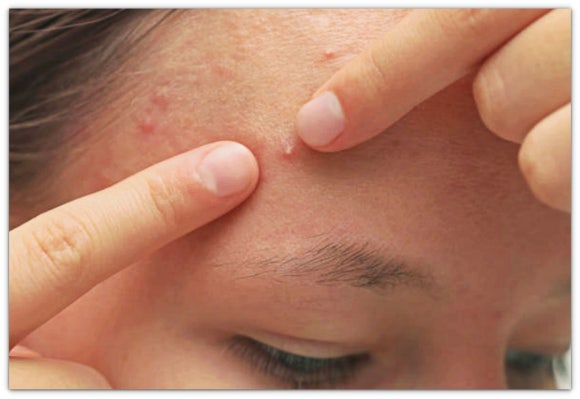 영등포여드름치료, 시술로 효과 보려면? 관련 이미지 8