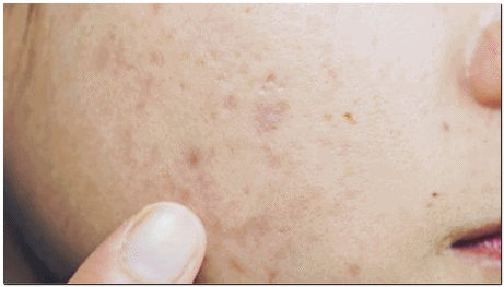 영등포여드름피부과 남자 여드름은 어떻게 치료해야 할까? 관련 이미지 12