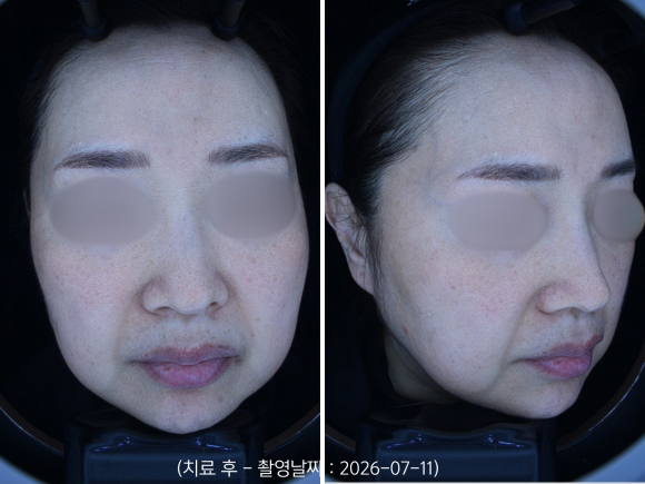 영등포 홍조치료, 안면홍조 레이저 받으면 붉은기가 좋아지나요? 관련 이미지 7