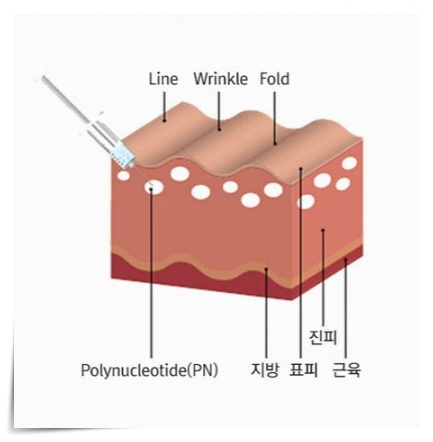 포텐자 펌핑팁 모공팁 무슨 차이가 있을까? 관련 이미지 6