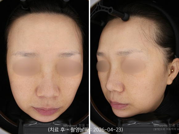 Yeongdeungpo Laser Toning: How Is Melasma That Developed After Childbirth Treated? image 7