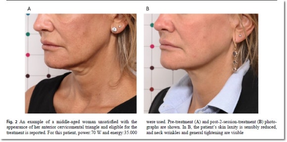 온다리프팅 이중턱 정리 효과, 어느 정도일까? 관련 이미지 4