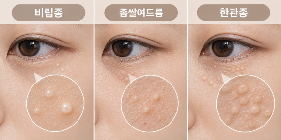 영등포비립종, 눈밑에 생기는 이유와 없애는 방법은? 관련 이미지 4