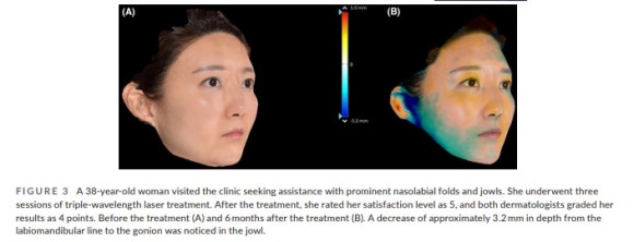 티타늄 온다 리프팅, 얼굴살이 고민일 때 효과적이다? 관련 이미지 5