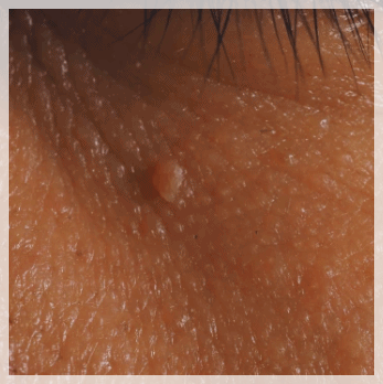 Flat Warts in Yeongdeungpo: You Need to Examine the Causes of Recurrence First image 4
