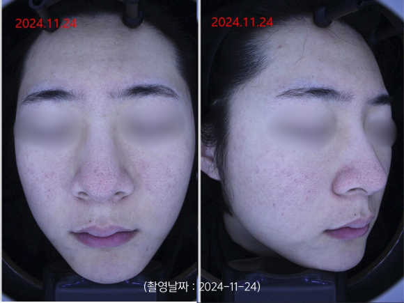 영등포 여드름 치료 사례 군대 전역 후 악화된 트러블 개선 관련 이미지 4