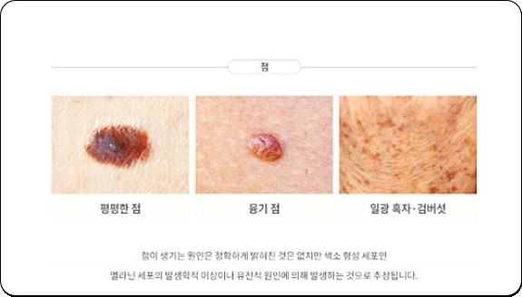 영등포점제거, 재발하는 진짜 이유 알려드립니다. 관련 이미지 6