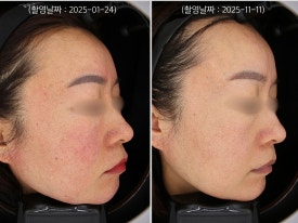 영등포 레이저토닝으로 홍조 치료한 사례 관련 이미지 6