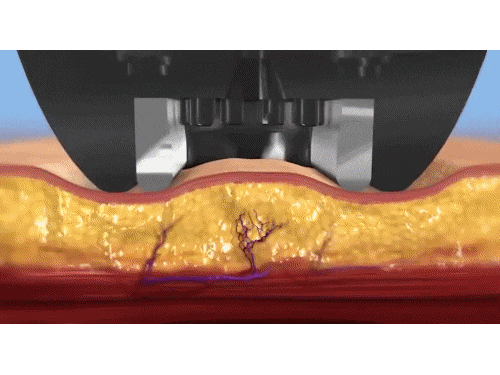 영등포인모드 리프팅 목적에 맞게 받아야 효과 봅니다 <의사 작성> 관련 이미지 2