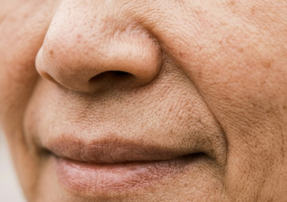 What Do You Think of the Combination of Jambersil and Juvelook for Nasolabial Folds? image 9