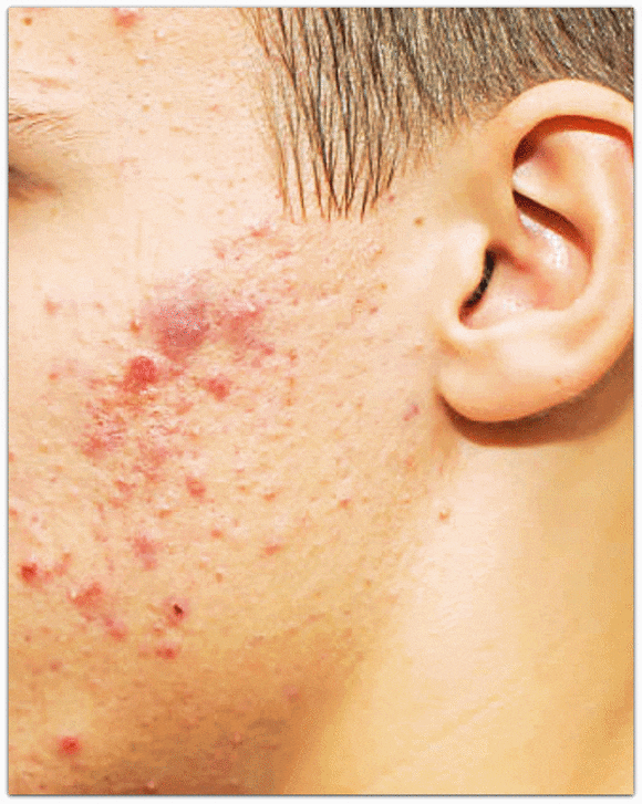 영등포여드름피부과 남자 여드름은 어떻게 치료해야 할까? 관련 이미지 1