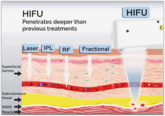 인모드 슈링크 주기, 어떻게 맞추면 좋을까? 관련 이미지 7