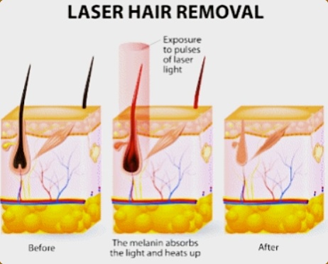 영등포역레이저제모, 시작 전 많이 물어보시는 질문들 정리 관련 이미지 2