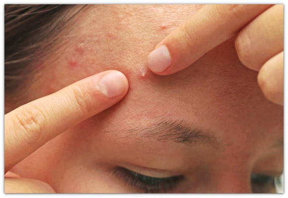 영등포아그네스 여드름 한관종에 모두 효과있다? 관련 이미지 3