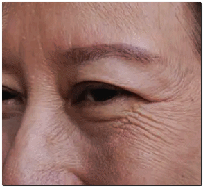 눈가 리프팅 종류, 탄력 잔주름에 효과 있는 것은? 관련 이미지 1