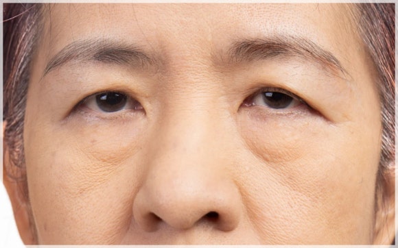 Does Eye Ulthera Work for Under-Eye Sagging? image 1