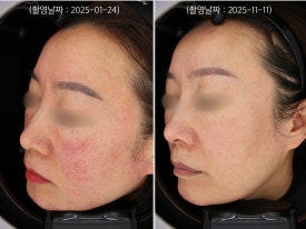 영등포 레이저토닝으로 홍조 치료한 사례 관련 이미지 5