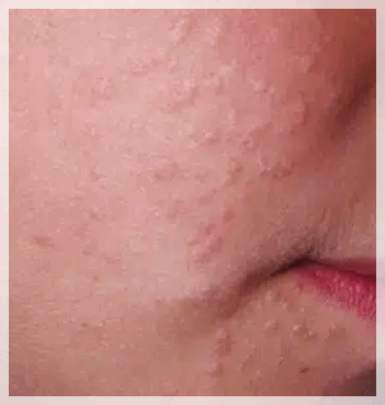Flat Warts in Yeongdeungpo: You Need to Examine the Causes of Recurrence First image 2