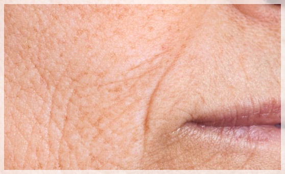 울쎄라피 써마지 차이 효과 비교 관련 이미지 5