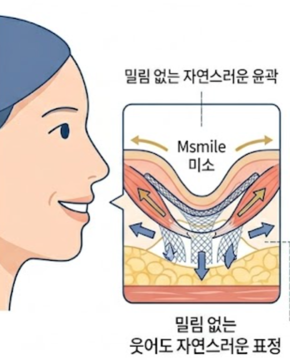 What Do You Think of the Combination of Jambersil and Juvelook for Nasolabial Folds? image 8