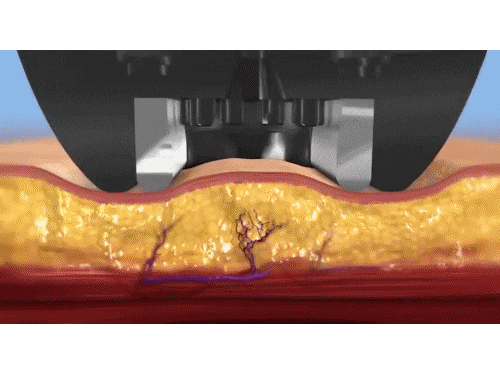 인모드 슈링크 효과 차이, 같이 받으면 어떨까? 관련 이미지 2