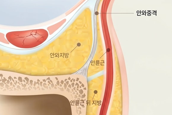 Does Eye Ulthera Work for Under-Eye Sagging? image 2
