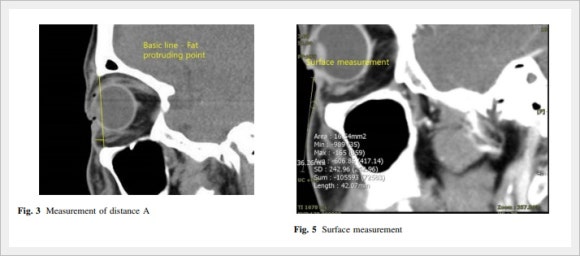 Does Eye Ulthera Work for Under-Eye Sagging? image 7