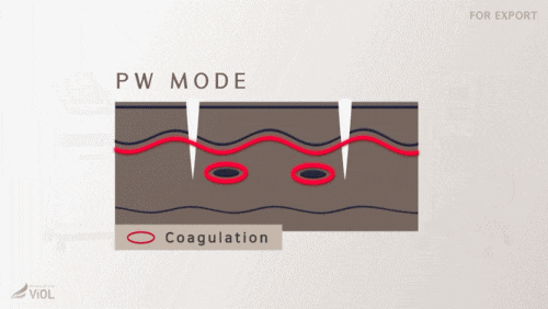 실펌x 레이저 효과 추천대상 통증은 어떨까? 관련 이미지 4