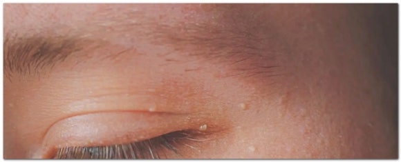 영등포사마귀 감염성 있다면 어떻게 대처하고 치료해야 할까? 관련 이미지 3