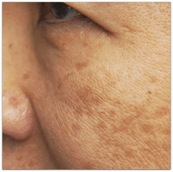 실펌x 레이저 효과 추천대상 통증은 어떨까? 관련 이미지 1