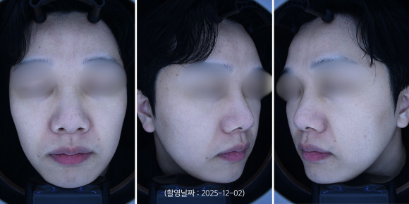 Yeongdeungpo Melasma and Dark Spots, How Many Laser Toning Sessions Will It Take? image 6
