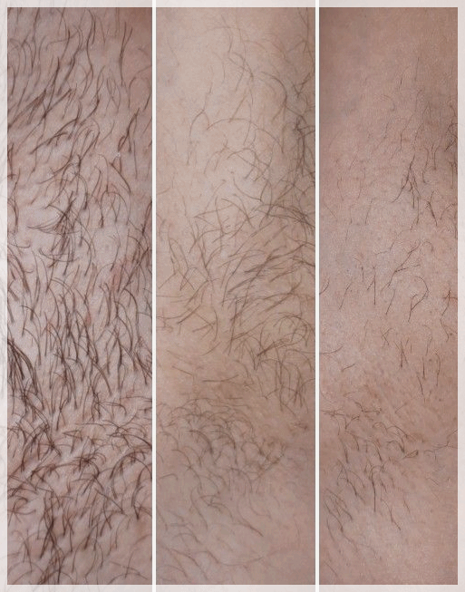Dangsan Station Dermatology Clinic for Hair Removal, Why Treatment Suited to You Matters image 2