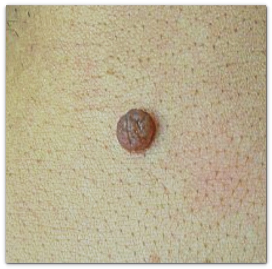 영등포점제거 깔끔하게 점빼기 가능할까? <재발 관련 내용 포함> 관련 이미지 5