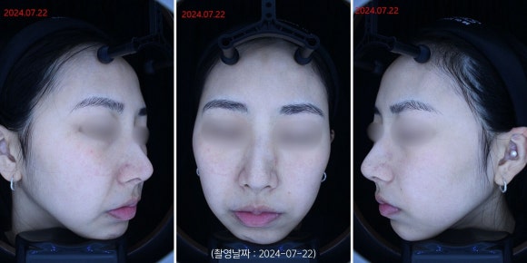 영등포 주근깨 레이저 치료 사례 관련 이미지 3