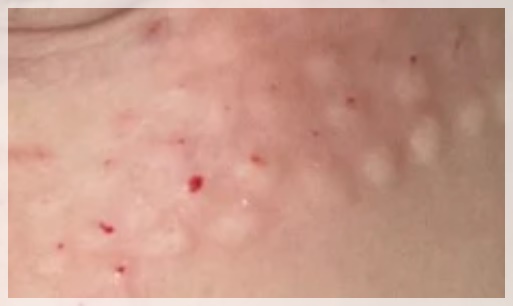 영등포 리쥬란 힐러 피부 재생 효과 보려면? 관련 이미지 7