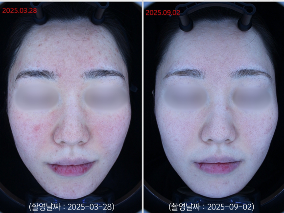 영등포 여드름 홍조 치료 사례 관련 이미지 5