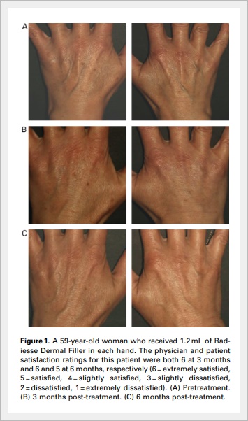 레디어스 손등 주름 시술 효과 어떨까? 관련 이미지 5