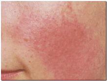 실펌x 레이저 효과 추천대상 통증은 어떨까? 관련 이미지 7