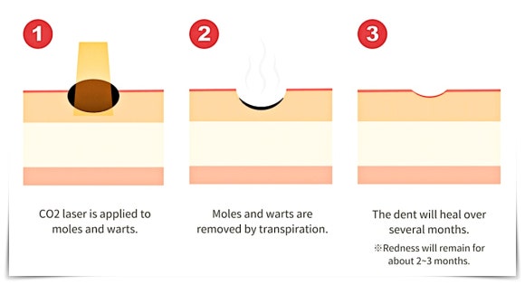 영등포점빼기 레이저 점제거 시술에 대한 오해와 진실 관련 이미지 5
