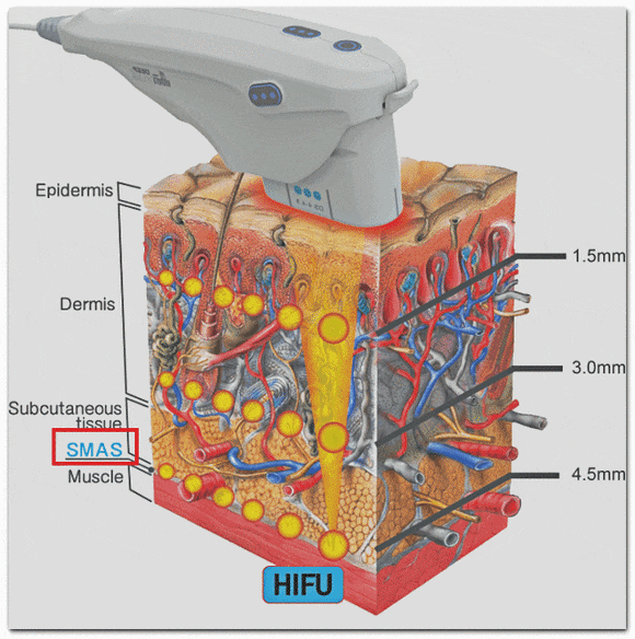 영등포 울쎄라 써마지 비교, 둘 중 뭐가 나을까? 관련 이미지 4