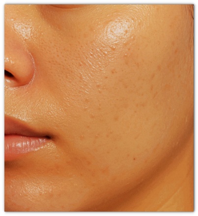 영등포시장 피부과 진료, 여드름 잡는 핵심은 관련 이미지 2